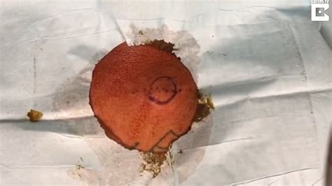 Largest Exploding Cyst 的图像结果