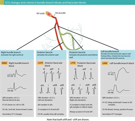Intraventricular conduction delay: bundle branch blocks & fascicular ...