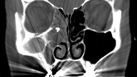 Wurzelfüllmaterial als Auslöser für Pilzbefall der Kieferhöhle ...