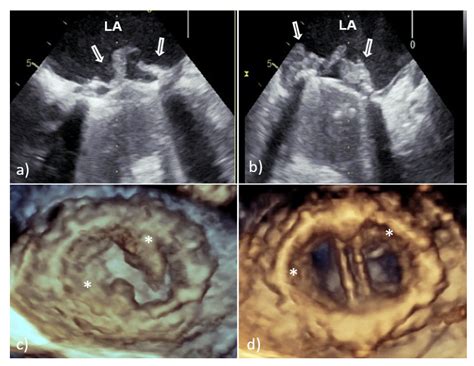Three-Dimensional Transesophageal Echocardiography in the Diagnosis and ...