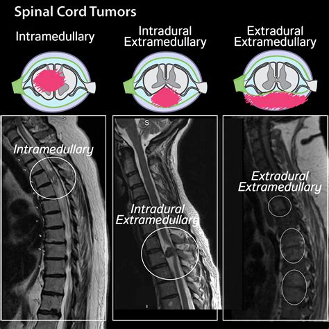 What Is A Tumor Of The Spinal Cord