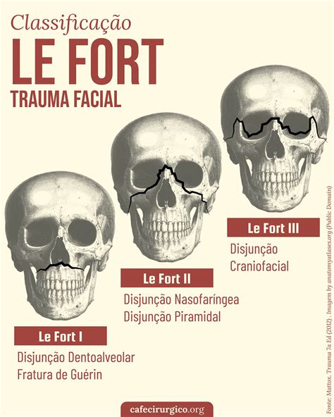 Fratura De Lefort Iii Le Fort III Osteotomy An Overview