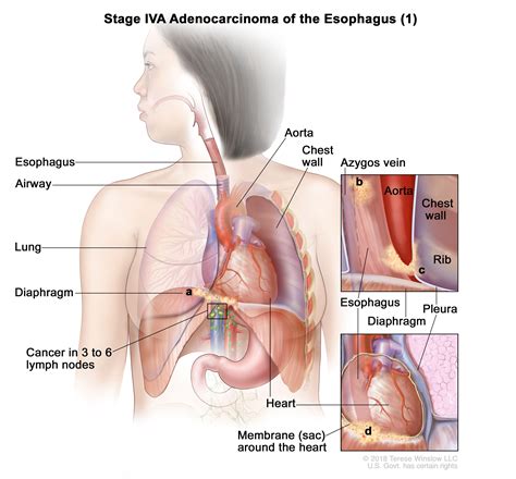 Esophagus Cancer Stage 4