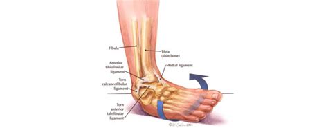 Lateral Ankle Sprain - Sydney Sports Physio & Rehab