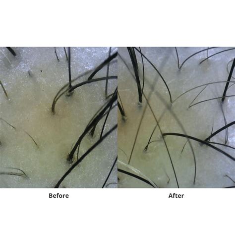 juliArt Hair Loss With Dry Scalp ECHO System – MANEPRINT