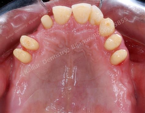 Image result for Partial Denture Procedure