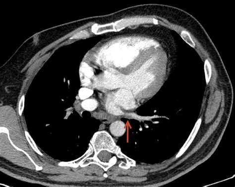 Recurrent haemoptysis as a symptom of severe pulmonary vein stenosis—a ...