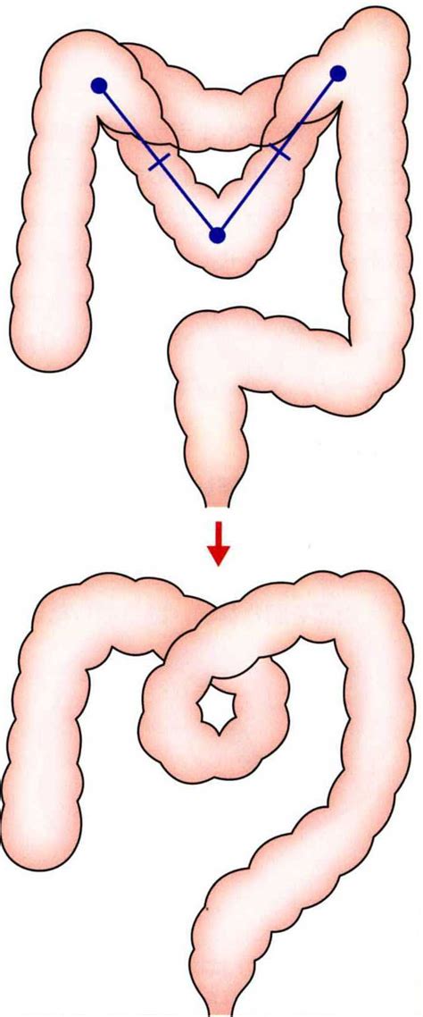 Image result for Loop Colonoscopy