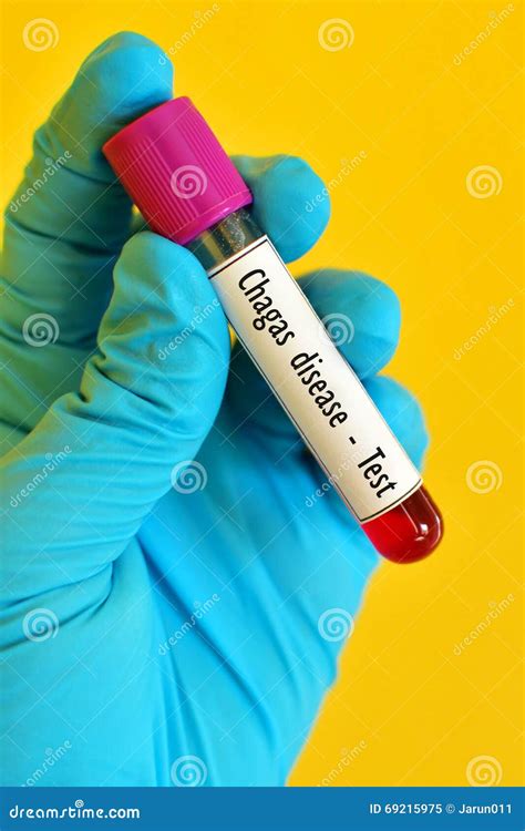 test for chagas disease Chagas yes - Diseases Club Center 2
