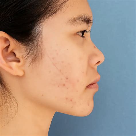 Fade Acne Scars Fast – Shop Proven Treatments Now – Tagged "Firm Skin" – Derma.pk