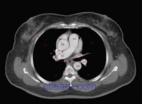 Ct Anatomy Of Thorax at Erin Page blog