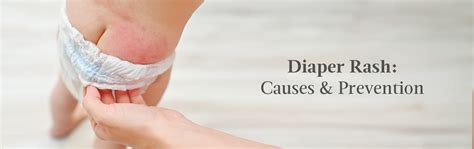 Understanding And Managing Diaper Rash: A Skin-Care Guide – AreoVeda