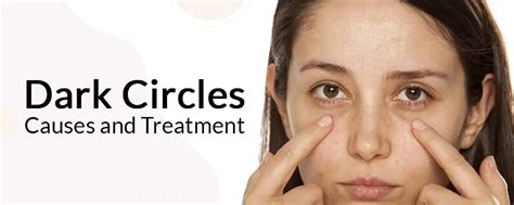 How do you get rid of under-eye dark circles – Fixderma Skincare