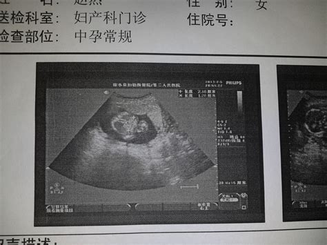 16周+2天胎儿腹腔内可见一大小约2.2*1.3cm的偏强回声怎么办？回声是什么？ - 百度宝宝知道