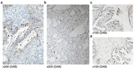 p53 Immunohistochemistry and Mutation Types Mismatching in High-Grade ...