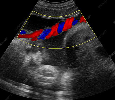 Bildergebnis für umbilical cord abnormalities ultrasound