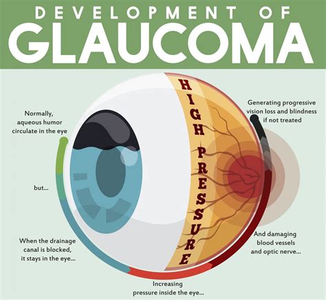 Glaucoma Evaluation and Treatment | Pocatello Eye Care