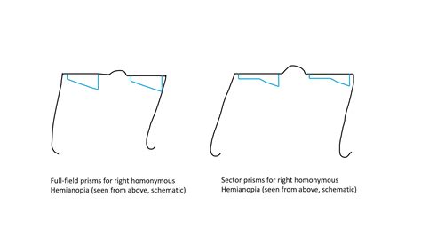 Homonymous Hemianopsia | Treatment & Management | Point of Care