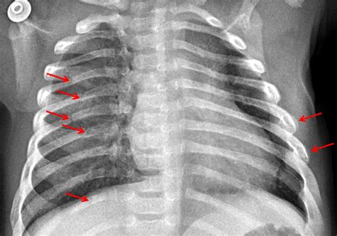 Xrays Of Broken Ribs