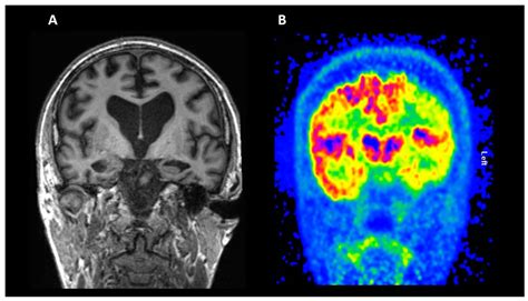 Imaging and Molecular Mechanisms of Alzheimer’s Disease: A Review