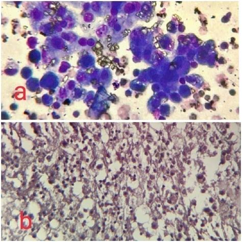 Cytomorphological evaluation of ascitic and pleural fluid with special ...