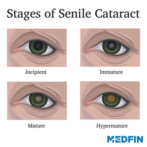 MedfinUntreated Cataract Leads to Loss of Vision? Read More! - Medfin