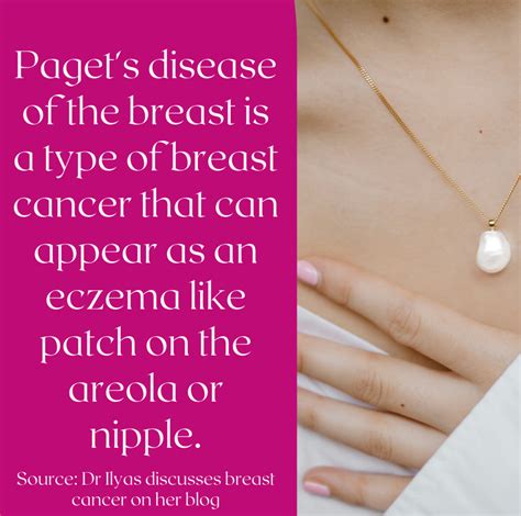 Paget's Disease Of The Nipple And Inflammatory Breast Cancer at Daryl ...