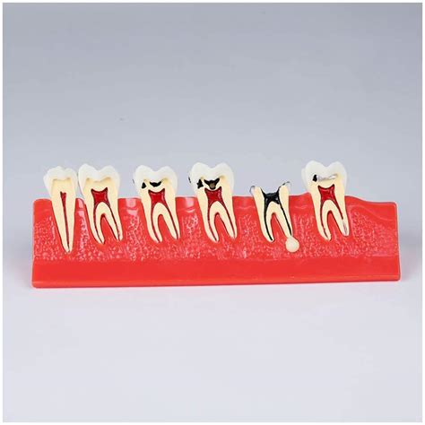 Dental Caries Template Teeth Anatomy Model Carry Development And ...
