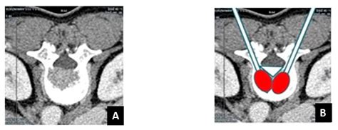 The Role of a Navigational Radiofrequency Ablation Device and ...
