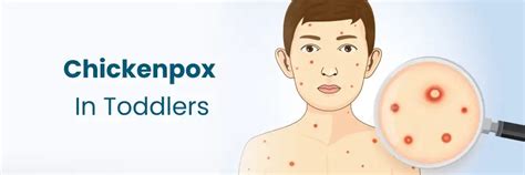Chickenpox Symptoms to Watch for in Toddlers
