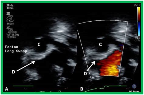 Double-Inlet Left Ventricle