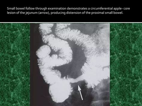 small_bowel_tumrs.pptx