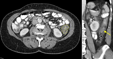 Image result for Colonic Diverticulum CT