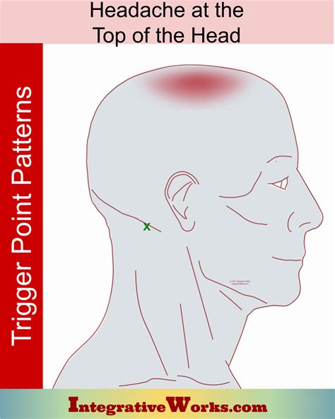 Headache on the Top of Your Head - Integrative Works