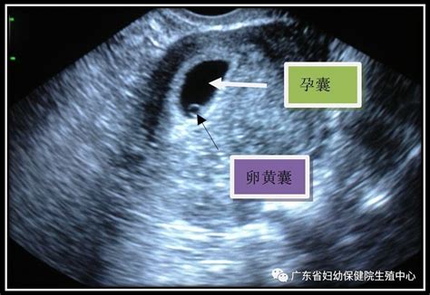 早孕超声解读 - 微医（挂号网）