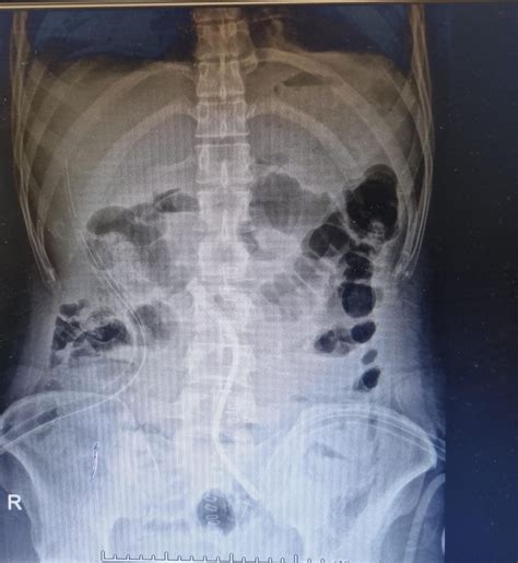 Doctors at Delhi hospital recover multiple coins, magnets from patient ...