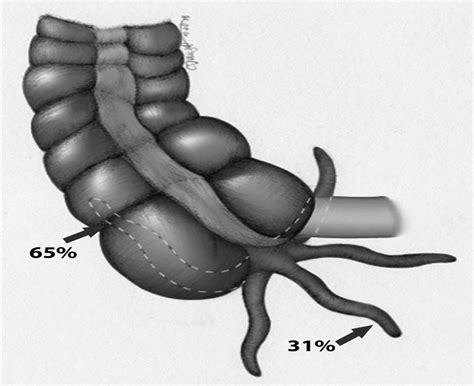 Image result for Normal Appendix Real