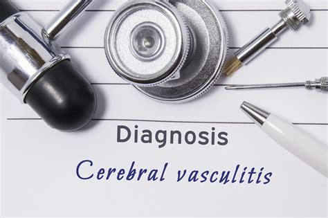 ANCA-Associated Vasculitis - Rare Disease Advisor