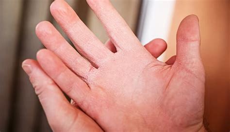 5 DIY Home Remedies for Dry Hands That Work Fast - lifeberrys.com