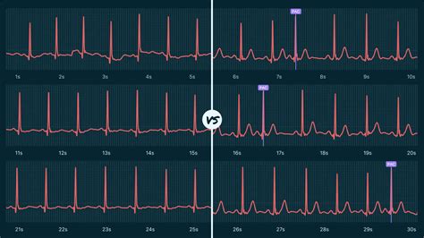 Sinus Rhythm Vs. Premature Atrial Contraction (Multiple) on Your Watch ...