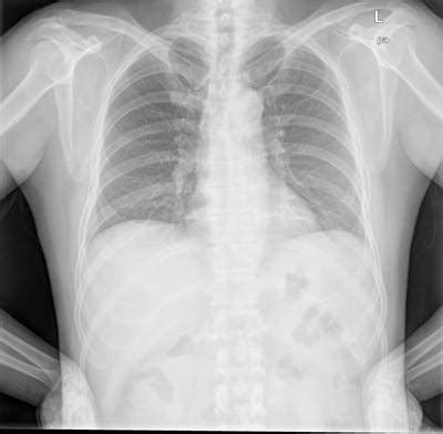 Chest Xray Masks and Labels - Dataset Ninja