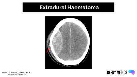 Types of Intracranial Haemorrhage | Bleeds | Geeky Medics
