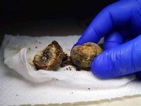 Gallstones and Gallbladder Disorders: Types, Symptoms, Cause and Cure
