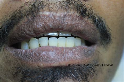 » Lower Front Tooth Replacement using dental implants