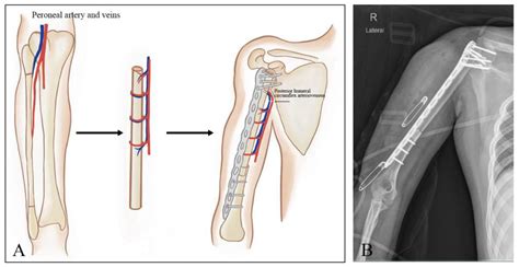 A Retrospective Study of the Functional Outcomes in Patients with ...