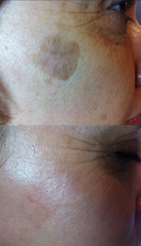 Buy Melasma Cream Remove Dark Sun Spot Acne Pimples Freckles Anti-Aging ...