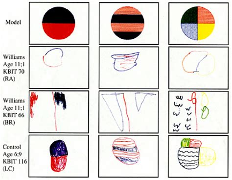 Image result for Visual Spatial Deficits