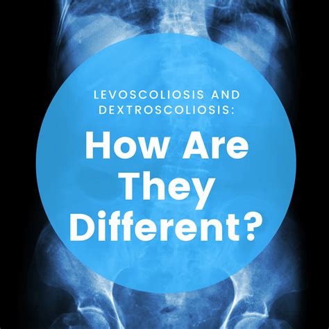 Levoscoliosis And Dextroscoliosis: How Are They Different? | New Jersey ...