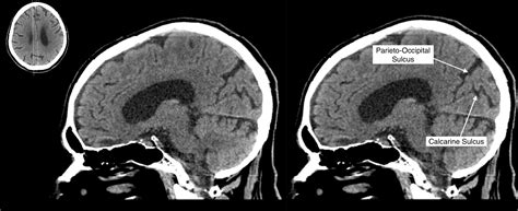 Parieto Occipital Sulcus