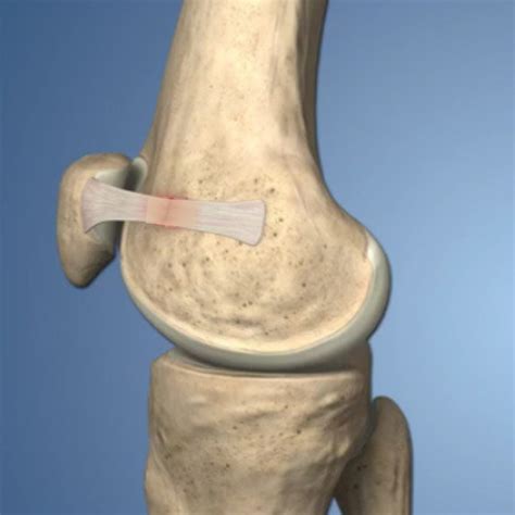 Medial Patellofemoral Ligament